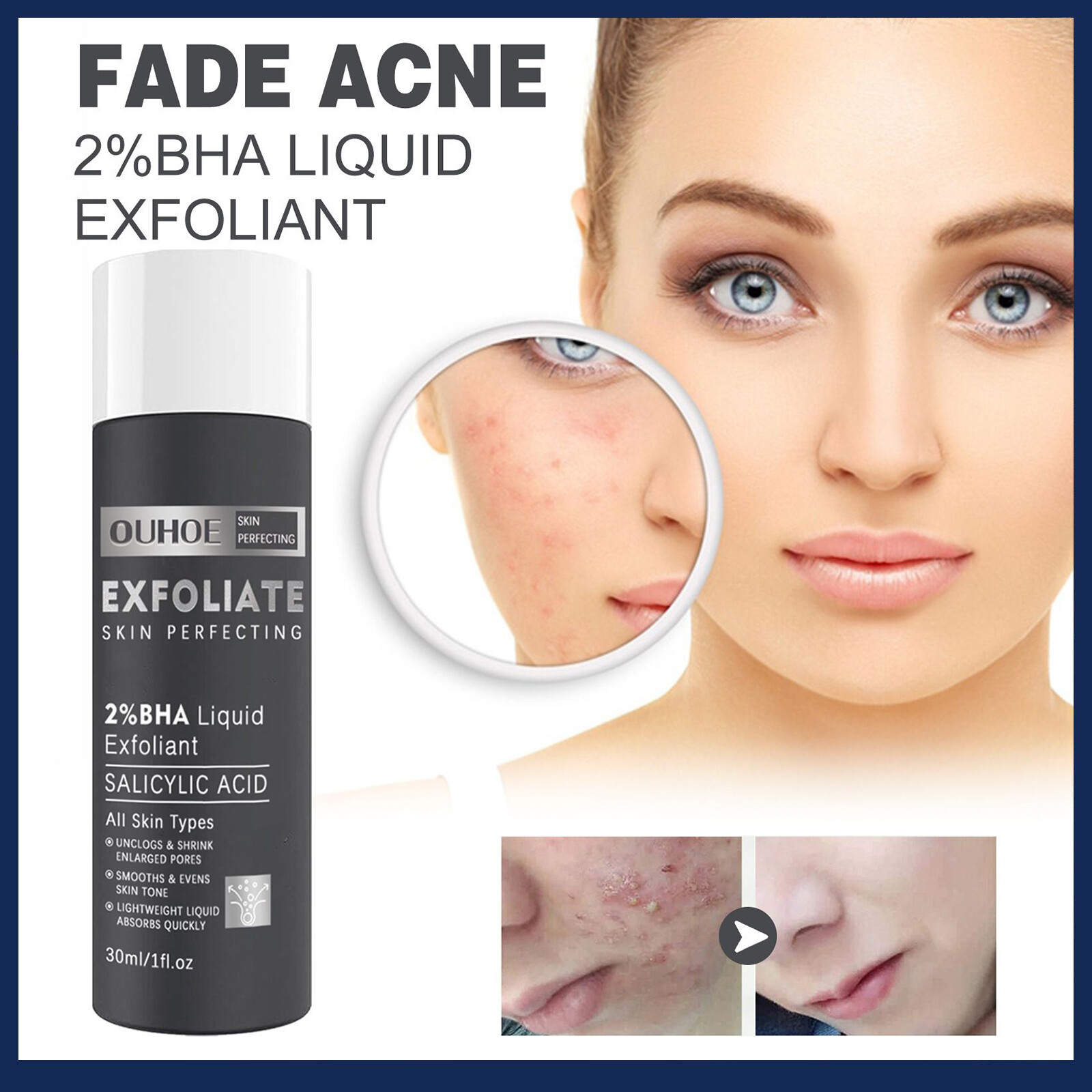  Ouhoe Fade Mụn Trứng Cá 2% Bha Lỏng Tẩy Tế Bào Chết Trên Khuôn Mặt Mụn Đầu Đen Spot Loại Bỏ chất đắp mặt 30Ml axit salicylic Essence lỏng Tẩy Tế Bào Chết cấp ẩm dưỡng ẩm Cây Trà điều trị mụn Huyết Thanh Giữ Ẩm Da Tinh Chất Cho tất cả các loại da Loại 