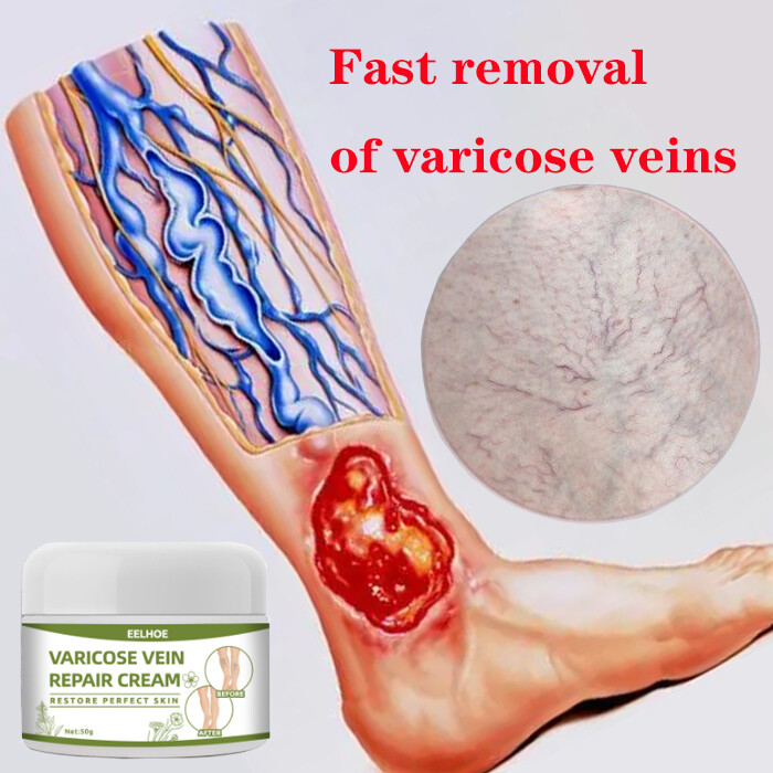 Gambar Quick removal Varicose veins Varicose Veins Ointment Varicose Veins Cream Vasculitis Treatment  Phlebitis Angiitis Spider Vein Cream  Improve Blood Circulation  Earthworm Legs Phlebitis Leg