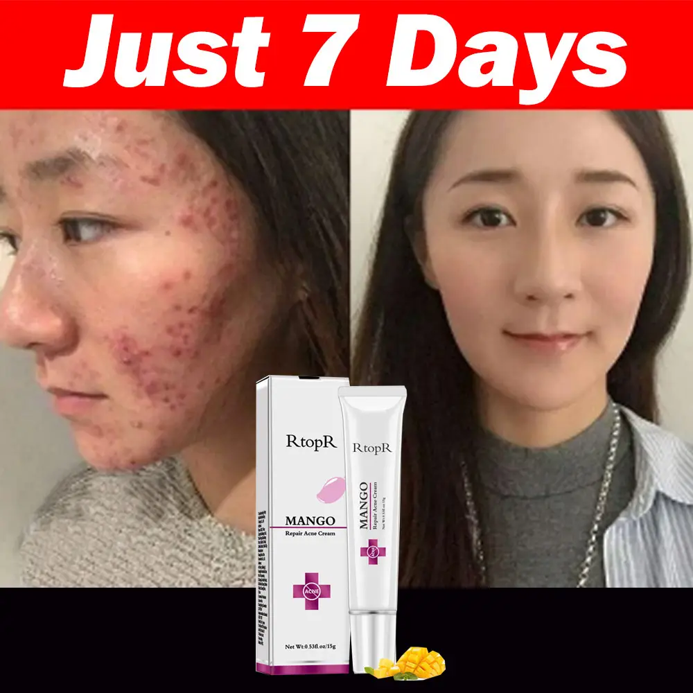 mango repair acne cream