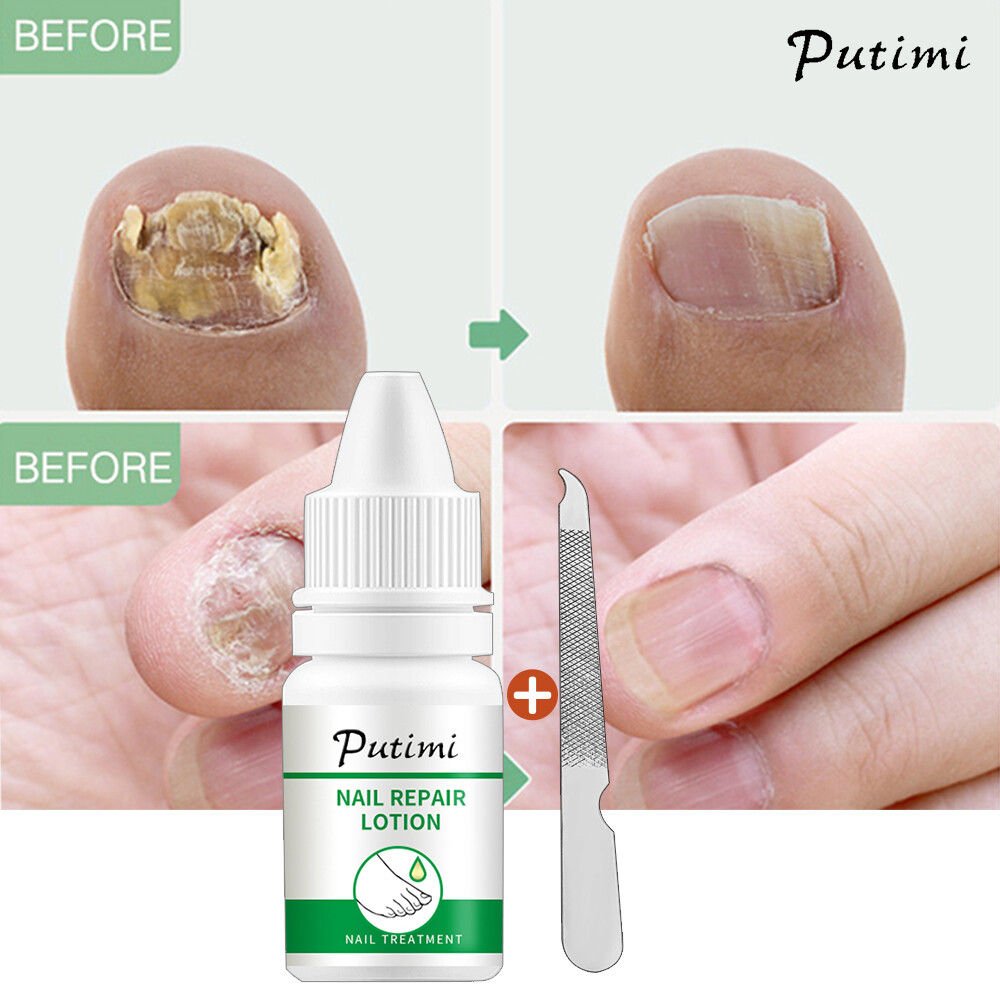 Putimi tinh dầu điều trị móng kháng khuẩn điều trị nấm móng paronychia chống nấm viêm móng chân chăm sóc làm sáng da tay chân 10ml