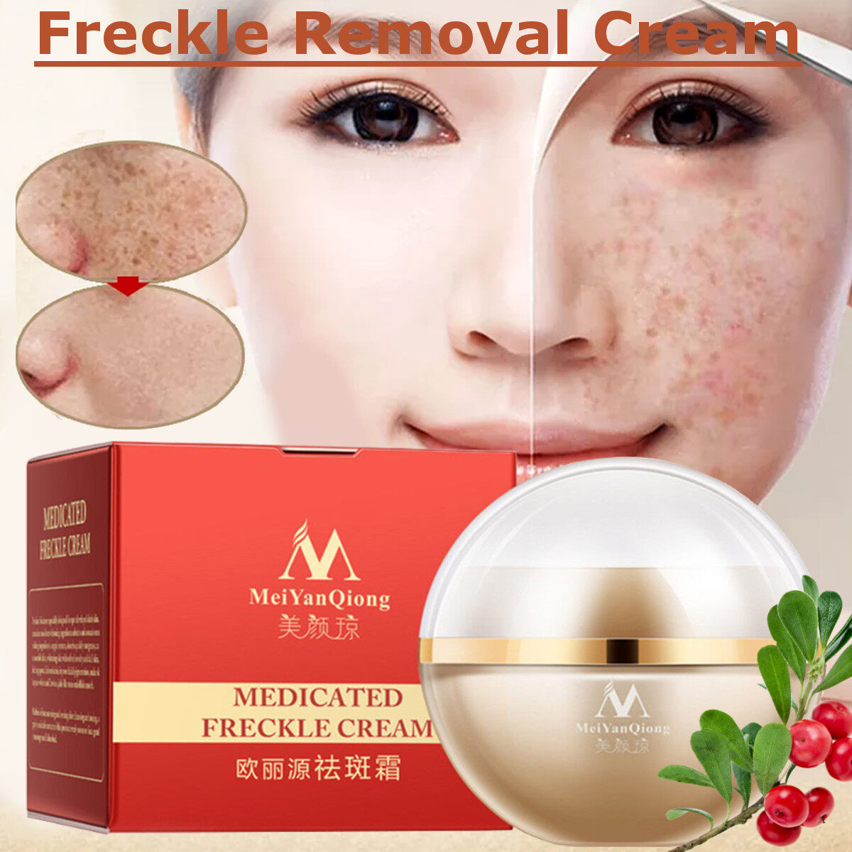 medicated freckle cream