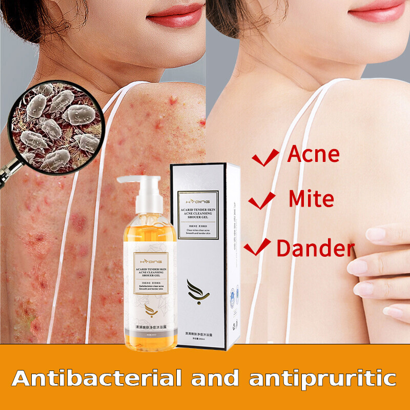 Gambar ??Ready stock?? acne body wash quickly remove Back mites and  acne shower gel Treatment Skin Dry Whitening body 260ml