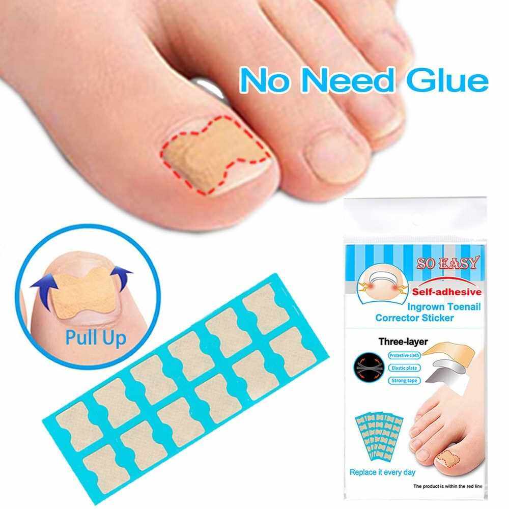 Ingrown Toenail Corrector Stickers Foot Care Stickers Non Glue Toenail ...